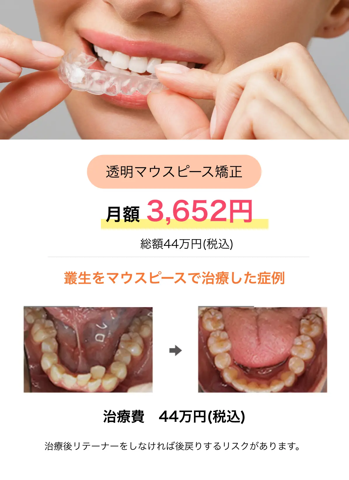 透明マウスピース矯正 月額 3,652円(税込)/総額44万円(税込)叢生をマウスピースで治療した症例 治療費　44万円(税込) ※治療後リテーナーをしなければ後戻りするリスクがあります。
