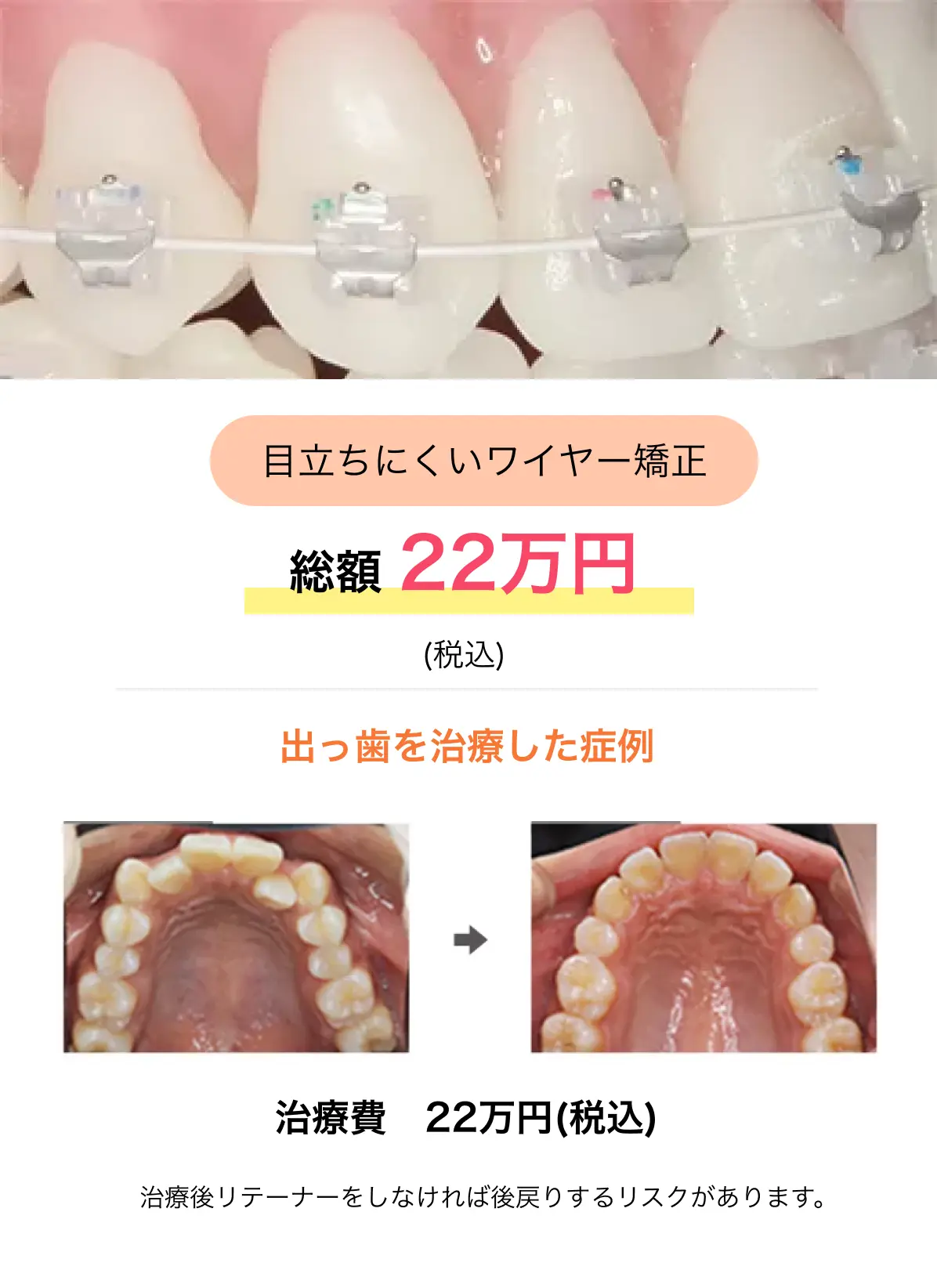 目立ちにくいワイヤー矯正/総額 22万円(税込)出っ歯を治療した症例 治療費 22万円(税込) 治療後リテーナーをしなければ後戻りするリスクがあります。
