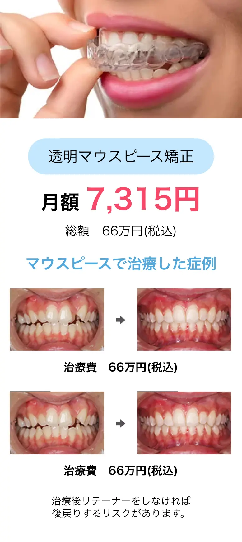 透明マウスピース矯正 月額 7,315円/総額 66万円(税込) マウスピースで治療した症例  1.治療費　66万円(税込)/2.治療費　66万円(税込)/治療後リテーナーをしなければ後戻りするリスクがあります。