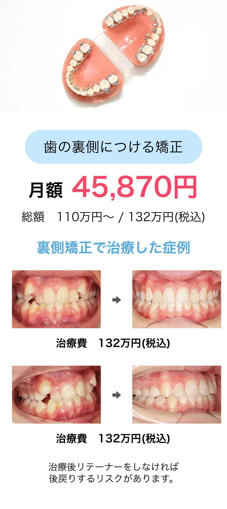 歯の裏側につける矯正月額 45,870円総額 110万円〜 / 132万円(税込)裏側矯正で治療した症例治療費　132万円(税込)治療費　132万円(税込)治療後リテーナーをしなければ
              後戻りするリスクがあります。