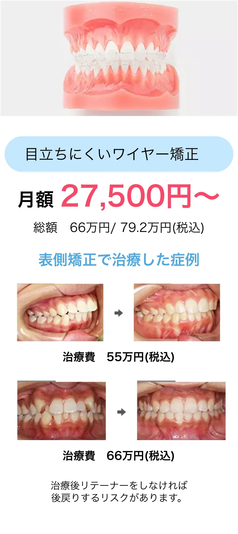目立ちにくいワイヤー矯正　月額 27,500円〜総額　66万円/ 79.2万円(税込) 表側矯正で治療した症例治療費　55万円(税込)治療費　66万円(税込)治療後リテーナーをしなければ
              後戻りするリスクがあります。