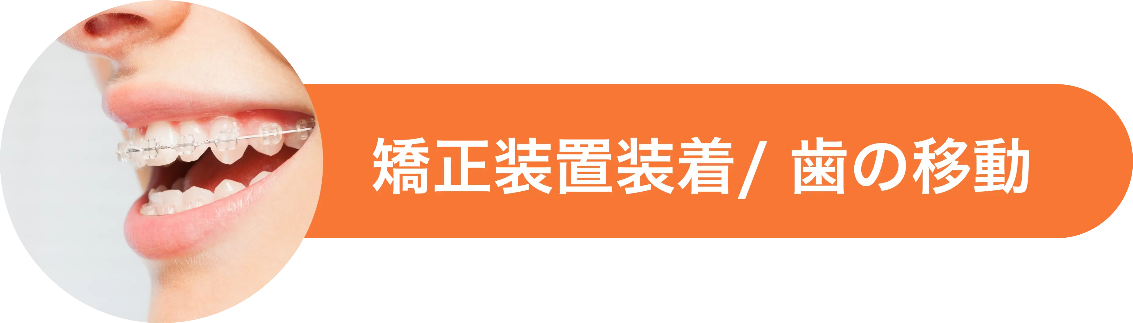 矯正装置の装着 (歯の移動)